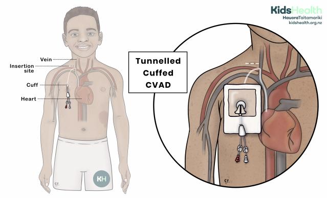 Child with a tunnelled cuffed central venous access device (CVAD) inserted into a vein in the upper chest. A magnified view shows the CVAD entering a vein below the collarbone and travelling to the heart.