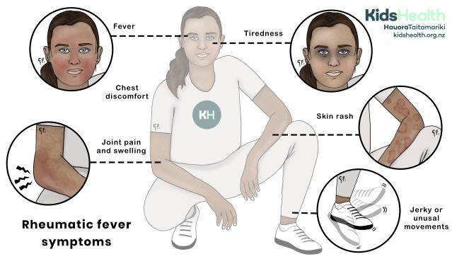 Child with common symptoms of rheumatic fever highlighted, including fever, tiredness, chest discomfort, joint pain and swelling, skin rash, and jerky or unusual movements.