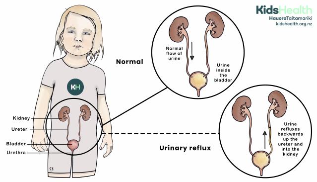 Illustration of a child showing the urinary tract, with a comparison between normal urine flow into the bladder and grade 1 urinary reflux, where urine flows partway back up the ureter.