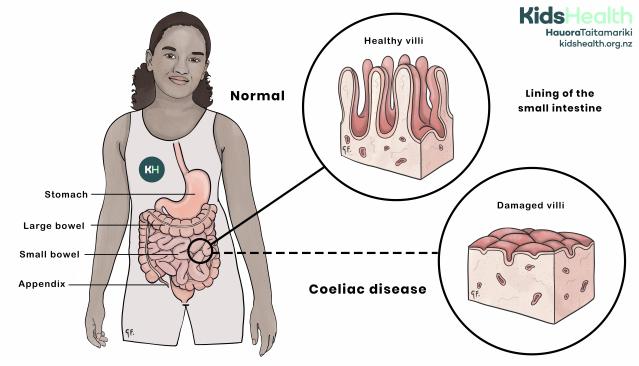Illustration of a child showing the digestive system, with close-up diagrams of the small intestine lining. The normal diagram shows healthy villi, while the coeliac disease diagram shows damaged villi.