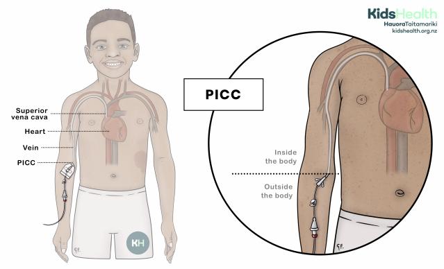 Child with a peripherally inserted central catheter (PICC) in a vein of the upper arm. A magnified view shows the PICC passing through a vein to the superior vena cava near the heart.