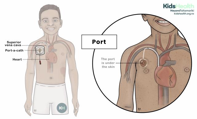 Child with an implanted port (Port-a-cath) under the skin of the upper chest. A magnified view shows the port under the skin connected to a catheter that travels through a vein to the heart.