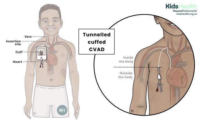 Illustration: Child with a tunnelled cuffed central venous access device (CVAD) inserted into a vein in the upper chest. A magnified back view shows the CVAD tunnelling under the skin before entering a vein and travelling to the heart.
