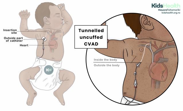 Child with a tunnelled uncuffed central venous access device (CVAD) inserted into a vein in the upper chest. A magnified view shows the CVAD tunnelling under the skin before entering a vein and travelling to the heart.
