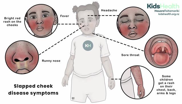 An illustration showing the symptoms of slapped cheek disease in a young child, including a bright red rash on the cheeks, fever, headache, sore throat, runny nose, and a body rash on the arms, chest, and legs.