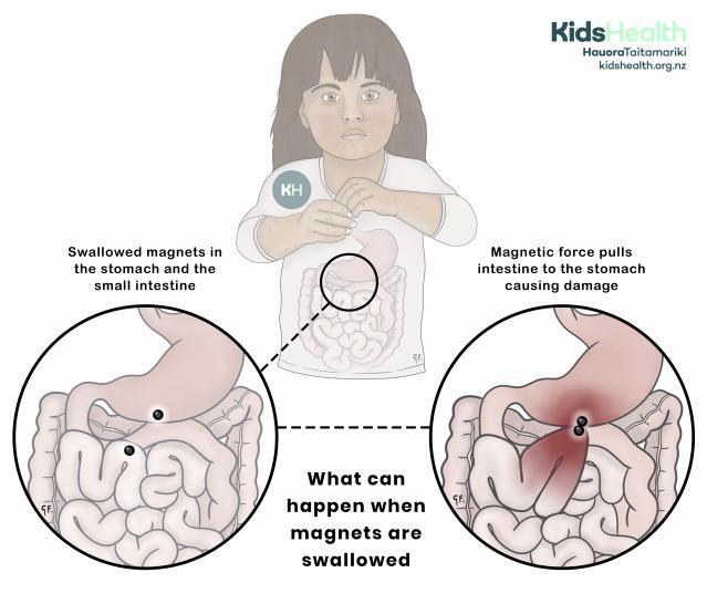Child with a view of the stomach and intestines. Magnified diagrams show swallowed magnets in the stomach and small intestine, and how the magnets can attract each other through the bowel wall and cause damage.