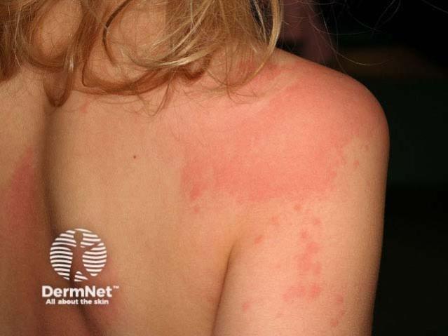 Child with a red, blotchy rash (hives) across the upper back and shoulder.