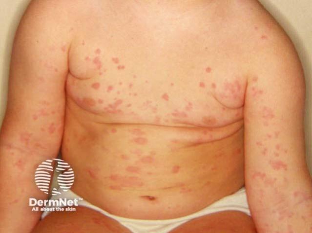 Child with a red, raised, blotchy rash (hives) across the chest, stomach and arms.