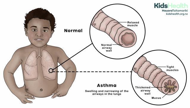 Illustration of a child showing a comparison between a normal airway and asthma. The normal airway has a relaxed muscle and clear passage, while the asthma airway shows tightened muscles, thickened airway walls, and mucus.