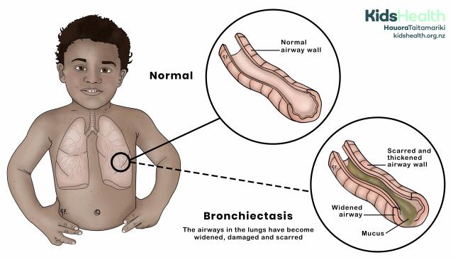 An illustration of a child with their lungs visible, showing a comparison between a normal airway and one affected by bronchiectasis. The normal airway is narrow with smooth walls, while the bronchiectasis airway is widened, scarred, and filled with mucus. Text explains that bronchiectasis causes damage and widening of the lung airways.