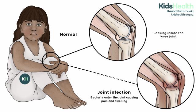 An illustration showing a child with a joint infection in the knee, with close-up views comparing a normal knee joint with an infected, inflamed knee joint.