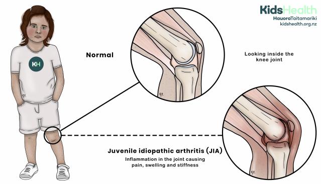 Illustration comparing a normal knee joint with a knee joint affected by juvenile idiopathic arthritis (JIA), showing inflammation around the joint.