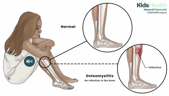 An illustration showing osteomyelitis in a child’s lower leg, with a close-up comparing a normal bone with a bone containing an area of infection.