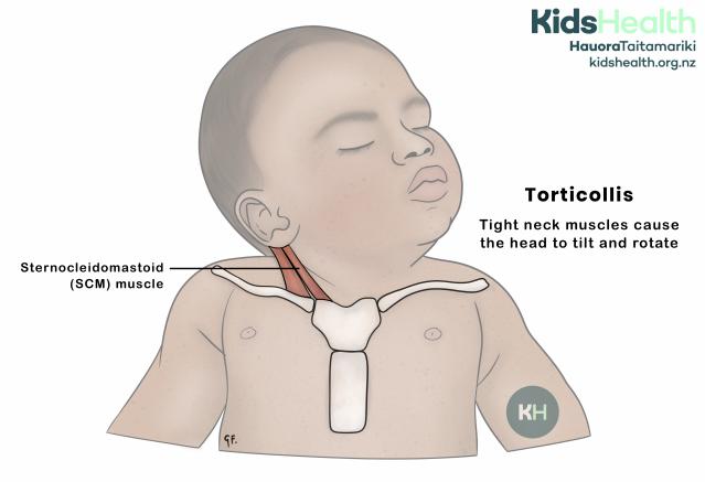 Illustration of a baby with torticollis, showing the head tilted and turned to one side and highlighting the sternocleidomastoid neck muscle.