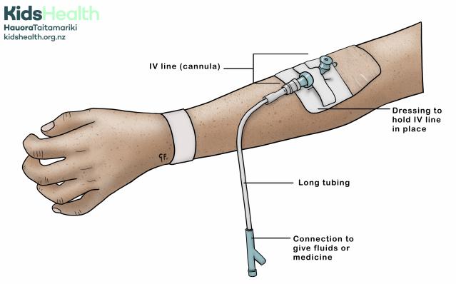 An illustration showing a child’s arm with an IV line (cannula) inserted into a vein. The IV line is held in place with a dressing and connects to long tubing used to give fluids or medicine.