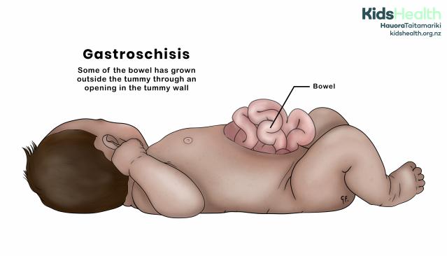 Illustration of a baby with gastroschisis, showing bowel outside the tummy through an opening in the tummy wall.