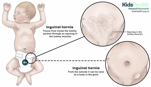 Illustration of a baby showing how tissue pushes through an opening in the tummy muscles and forms a lump in the groin called and inguinal hernia.