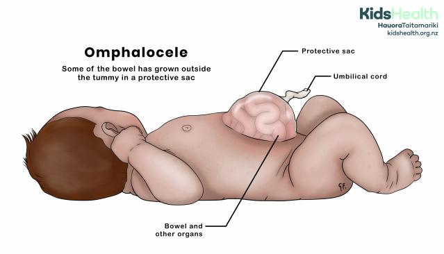 Illustration of a baby with an omphalocele, showing bowel and other organs outside the tummy inside a protective sac.