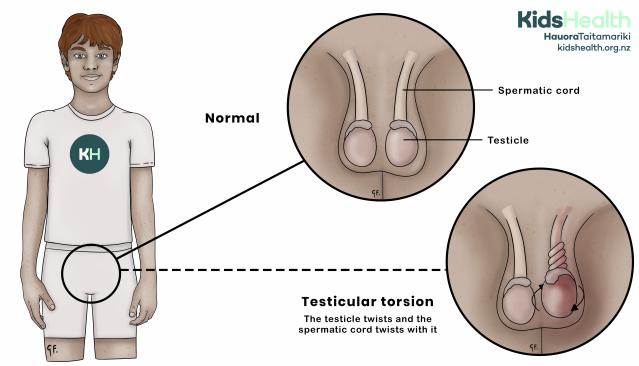 Illustration of a teenage boy comparing normal testicles with testicular torsion, where a testicle and its spermatic cord have twisted.