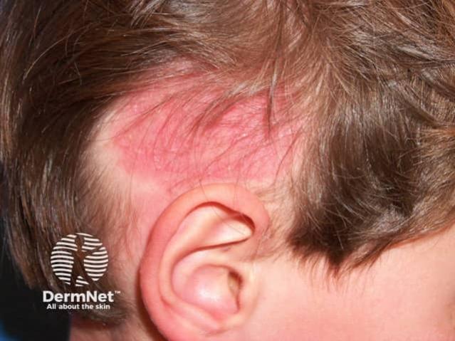 Close-up of scalp ringworm, showing a red, scaly patch with an area of hair loss above a child’s ear.