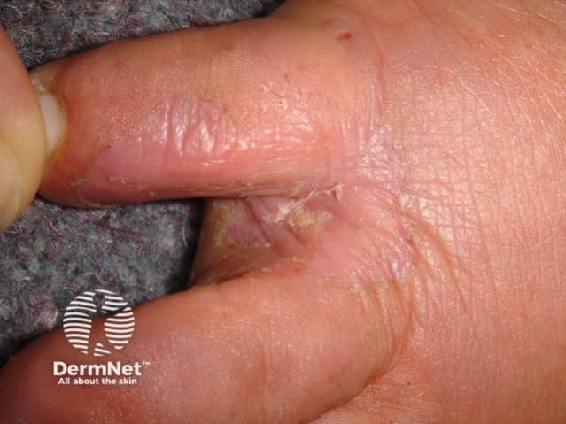 Close-up of athlete’s foot between a child’s toes, showing red, cracked and peeling skin.