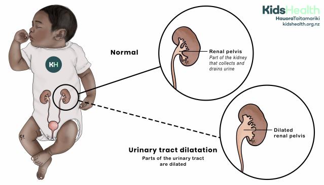 Illustration of a baby’s urinary tract comparing a normal renal pelvis with a dilated renal pelvis.