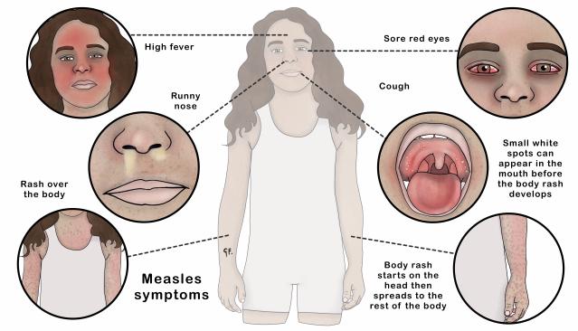Illustration of measles symptoms in a young child, highlighting signs such as high fever, sore red eyes, runny nose, cough, and a rash that begins on the head and spreads over the body. Inset views show details like white spots in the mouth and the characteristic body rash associated with measles.