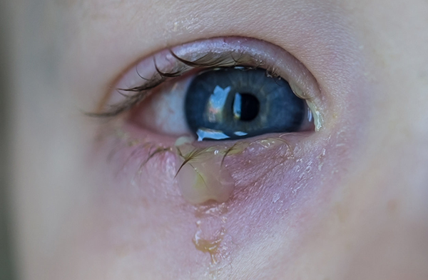A photo of a boy with conjunctivitis