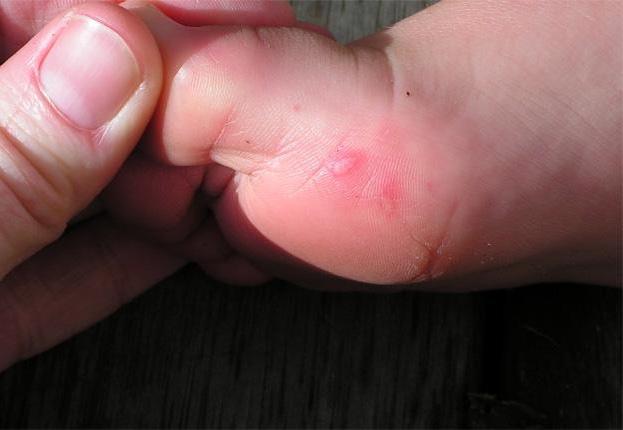 Foot blisters on a child with hand, foot and mouth diease