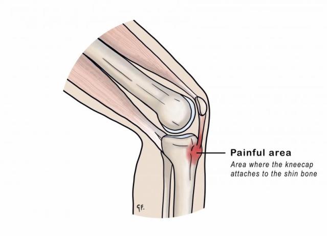 Illustration showing painful area of knee in osgood schlatter disease