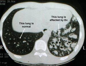 Chest CT scan showing Bx in one lung