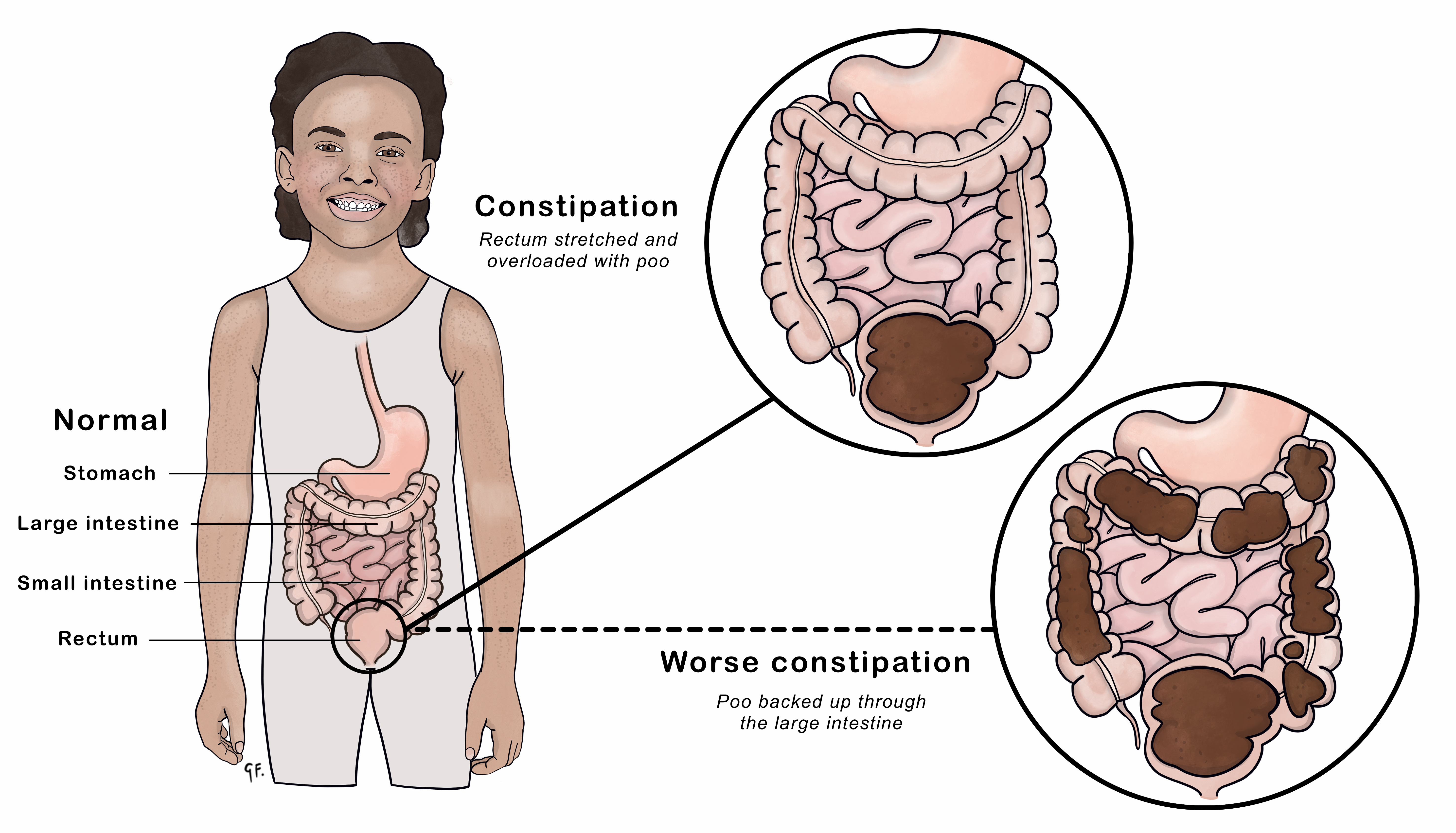 Constipation  KidsHealth NZ