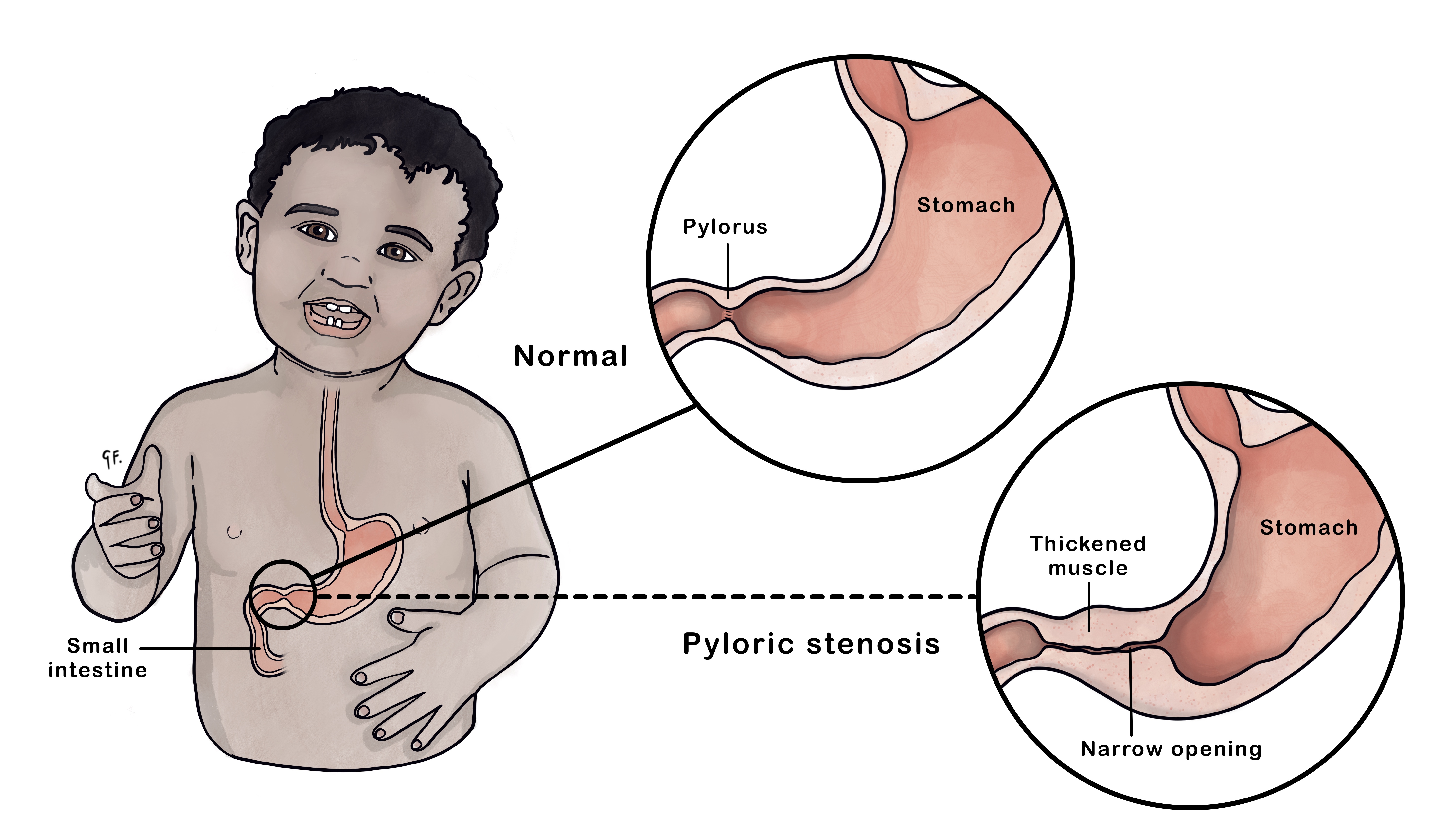 Pyloric Stenosis | KidsHealth NZ