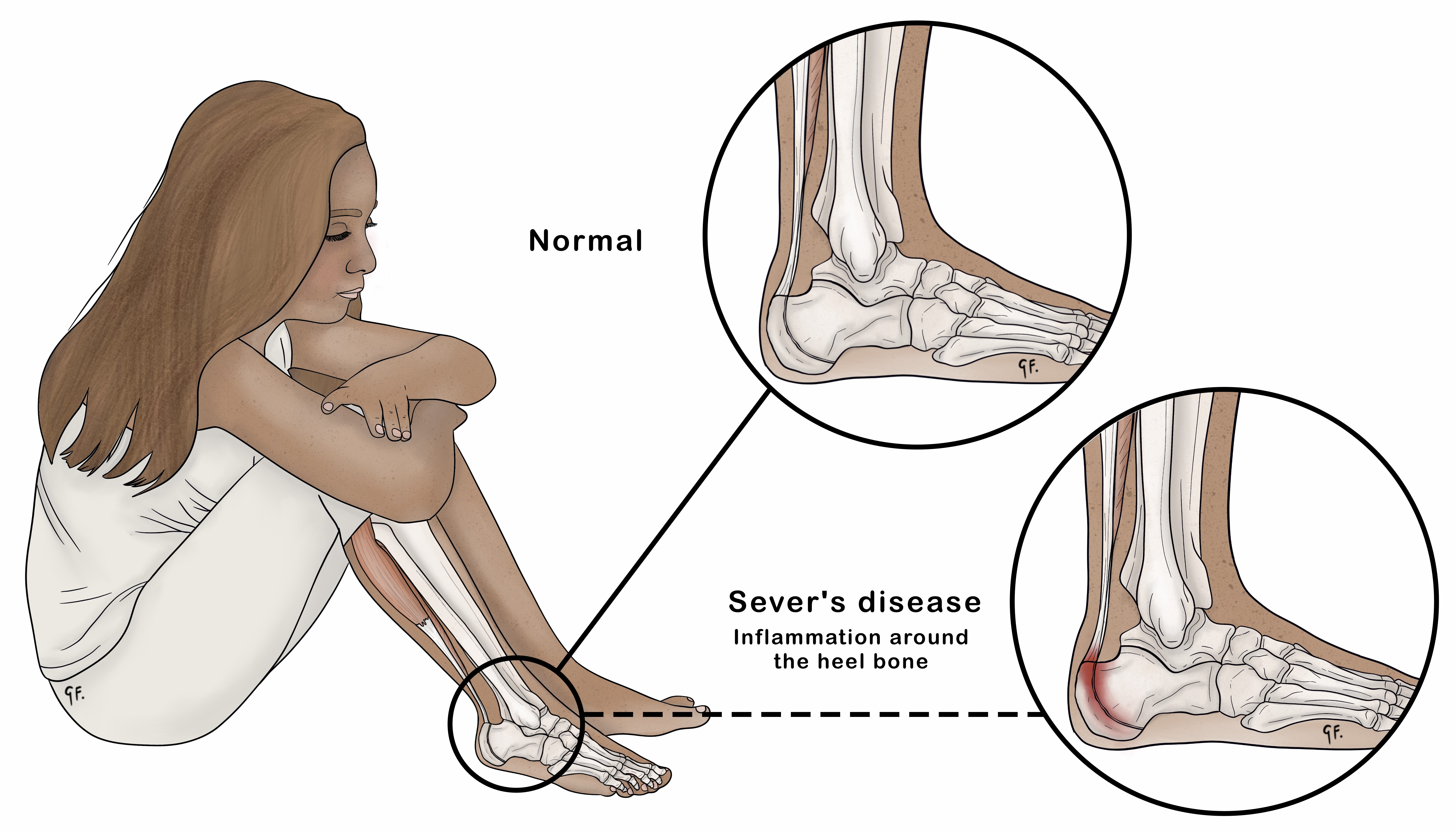 Sever's Disease | KidsHealth NZ