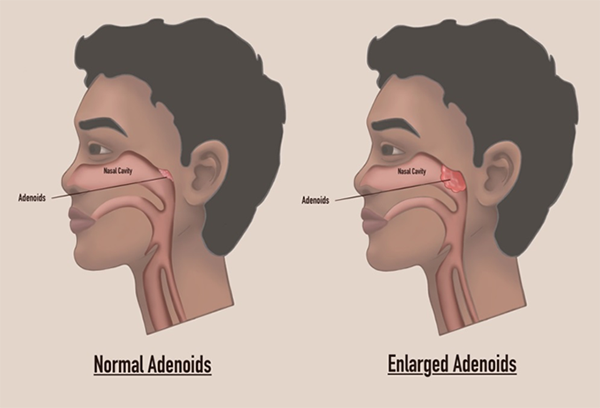 Tonsil Removal Before And After