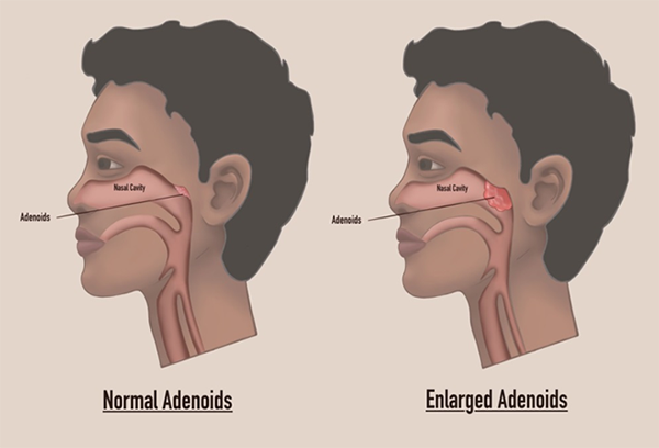 Picture of normal and enlarged adenoids 