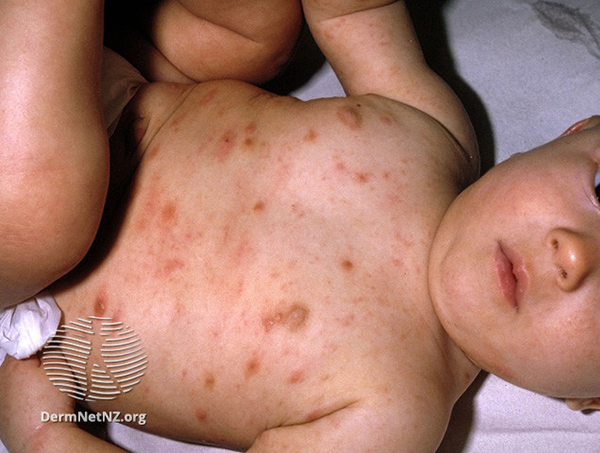 Baby with scabies