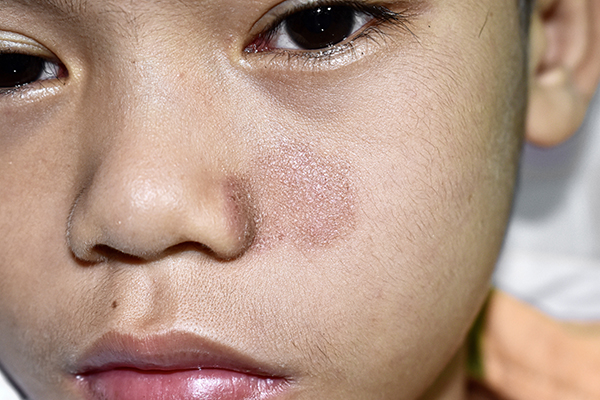 A young boy with ringworm on his face