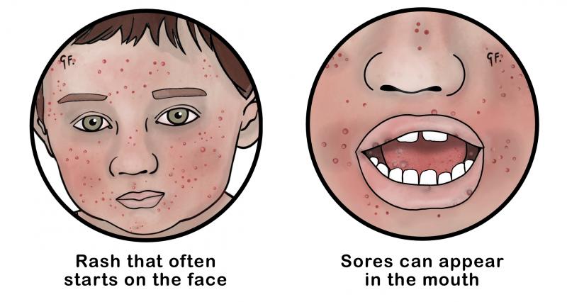 Illustration of the symptoms of chickenpox 