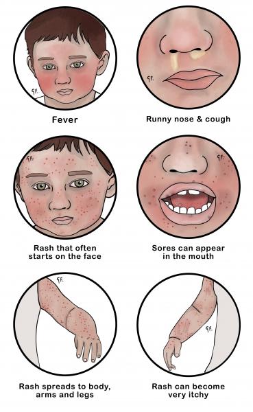 Illustration of the symptoms of chickenpox 