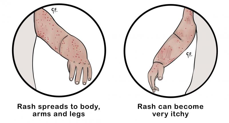 Illustration of the symptoms of chickenpox 