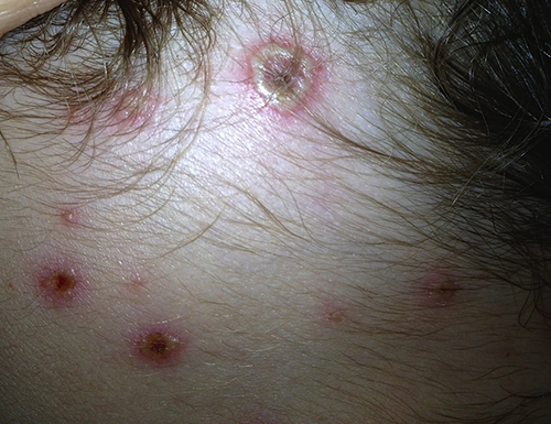 chicken pox pictures in adults