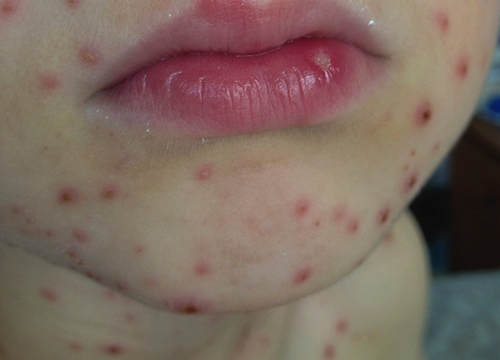 Photo of a chickenpox rash on a child's face