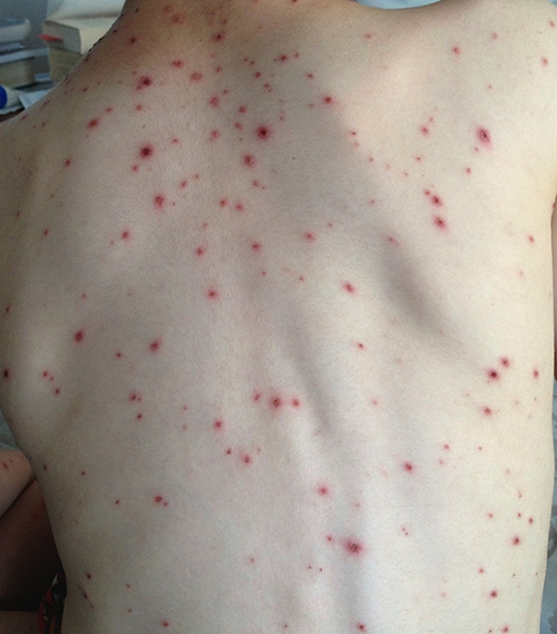 Chickenpox rash on a child's back