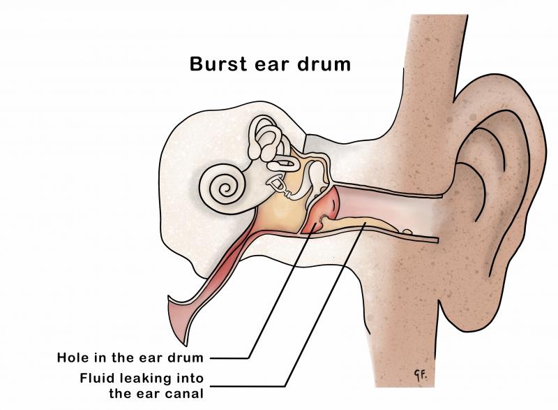 Pus bursting through the ear drum