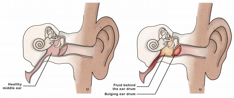 Illustration showing inner ear anatomy and an ear infection or otitis media