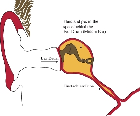 fluid and pus in the space behind the ear drum (middle ear)