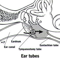 Diagram of a grommet in place in the ear drum