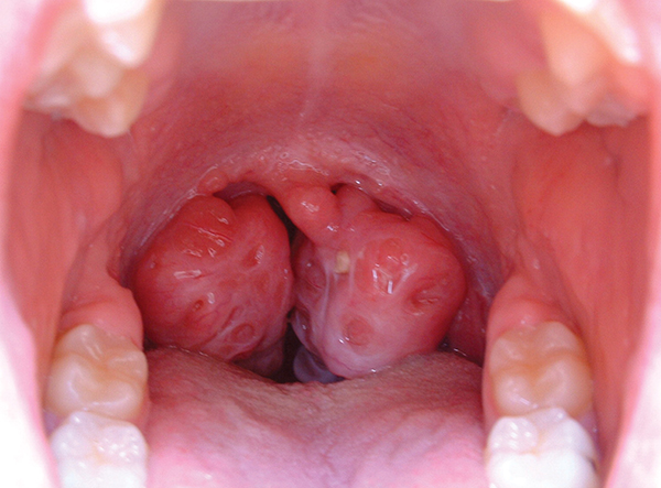 An open mouth showing enlarged tonsils