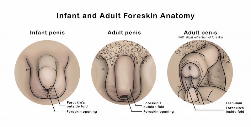 medical illustration showing an infant foreskin and adult foreskin with retraction of adult foreskin